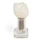 Bicuspid Implant Study Model